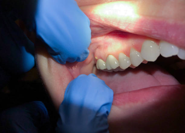 Best Lost Filling or Crown Replacement in Auburn, CA